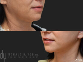 Deep plane facelift and necklift