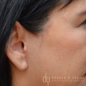 Deep plane facelift