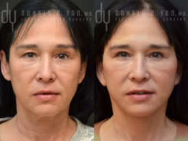 Deep plane facelift