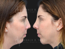 Rhinoplasty and chin augmentation