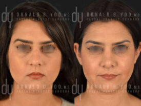 Primary rhinoplasty