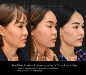 Revision rhinoplasty with rib cartilage, diced cartilage fascia (DCF) and silicone implant removal