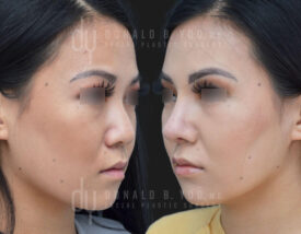 Asian Rhinoplasty with rib cartilage and diced cartilage fascia (DCF)