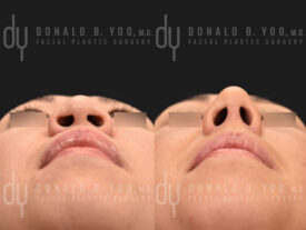 Asian rhinoplasty with rib cartilage, diced cartilage fascia (DCF) and alarplasty