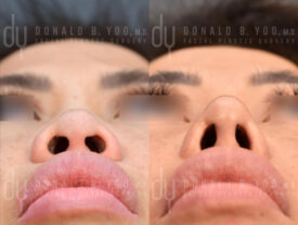 Asian rhinoplasty with rib cartilage, diced cartilage fascia (DCF) and alarplasty
