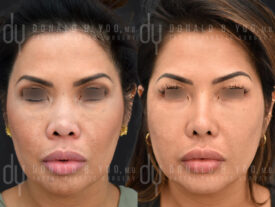 Primary Asian Rhinoplasty with rib cartilage and diced cartilage fascia (DCF)