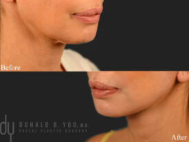 Deep plane facelift