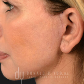 Deep plane facelift