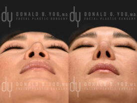 Revision rhinoplasty with rib cartilage, diced cartilage fascia (DCF) and silicone implant removal