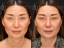 Revision Asian Rhinoplasty with rib cartilage, diced cartilage fascia (DCF) and implant removal