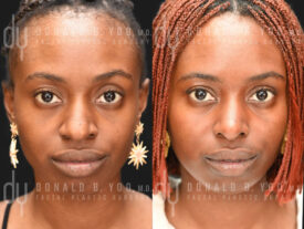 Primary rhinoplasty and alarplasty