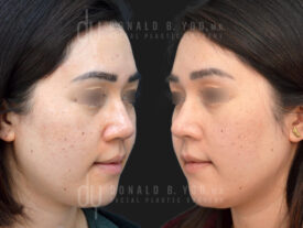 Asian Rhinoplasty with rib cartilage and diced cartilage fascia (DCF)