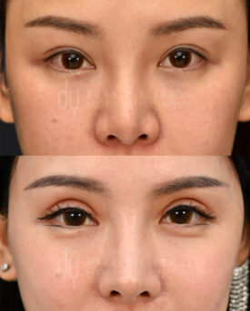 Revision upper blepharoplasty