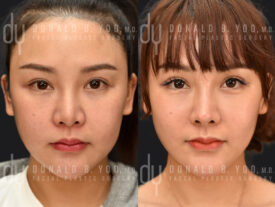 Revision rhinoplasty with rib cartilage, diced cartilage fascia (DCF) and silicone implant removal
