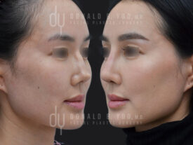 Revision Asian Rhinoplasty with rib cartilage and diced cartilage fascia (DCF)