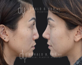 Asian Rhinoplasty with rib cartilage and diced cartilage fascia (DCF)