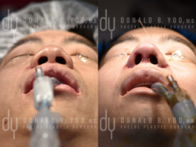 Asian rhinoplasty with rib cartilage, diced cartilage fascia (DCF) and alarplasty