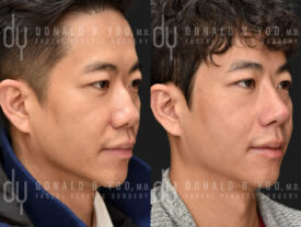 Male rhinoplasty with rib cartilage and diced cartilage fascia (DCF)
