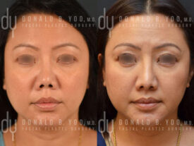 Revision rhinoplasty with rib cartilage, diced cartilage fascia (DCF) and silicone implant removal