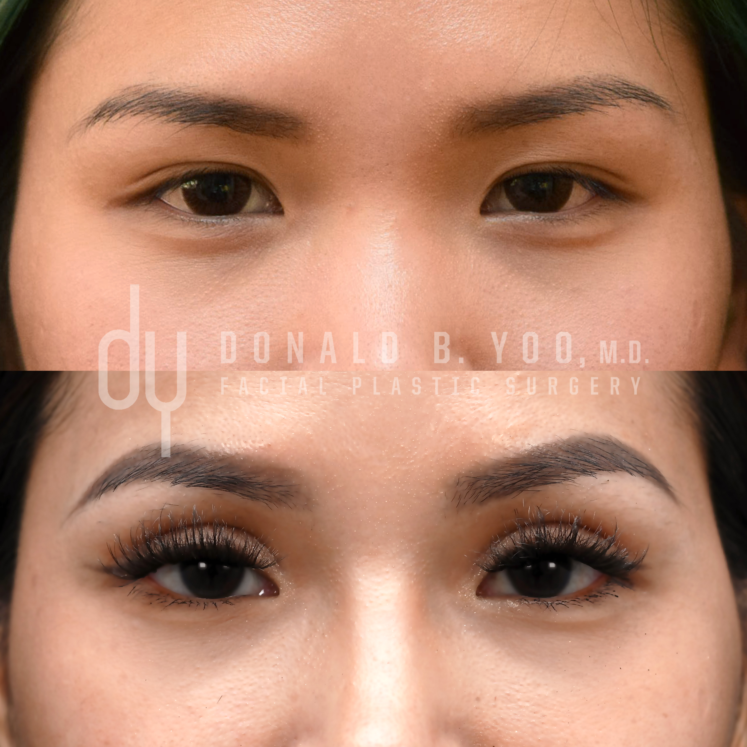 Before (top) and after (bottom) Asian upper blepharoplasty, frontal view, low eyelid crease corrected with a visible new crease