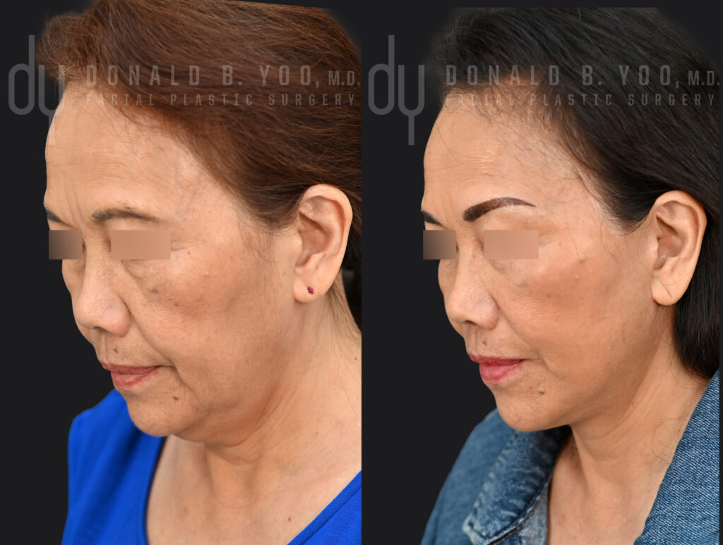 Left three-quarter view before (left) and after (right) deep plane facelift with neck lift