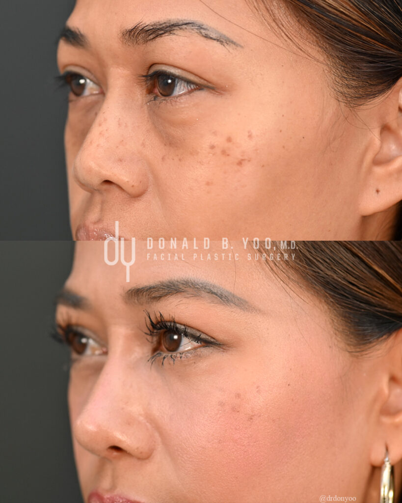 Before (top) and after (bottom) lower blepharoplasty with rhinoplasty, oblique view, Dr. Donald Yoo, Beverly Hills