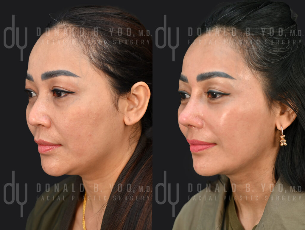 Left three-quarter view before (left) and after (right) rib cartilage rhinoplasty with diced cartilage fascia and alarplasty