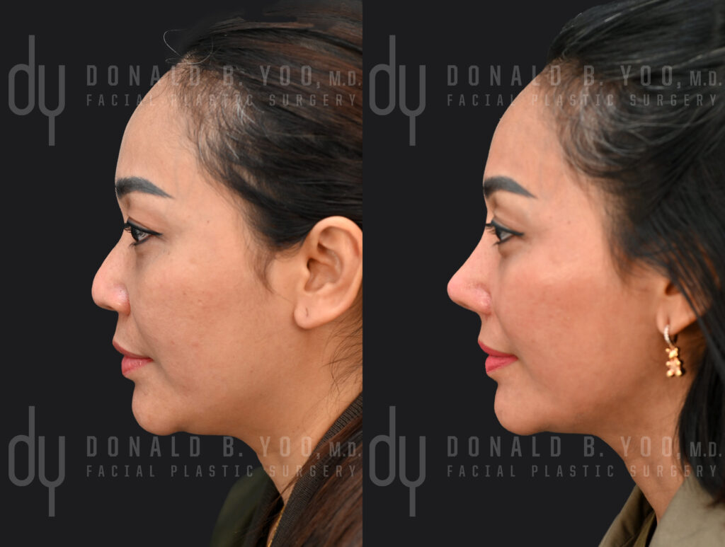 Left profile view before (left) and after (right) rib cartilage rhinoplasty with diced cartilage fascia and alarplasty