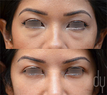 Before and After Photo of Lower Blepharoplasty Procedure