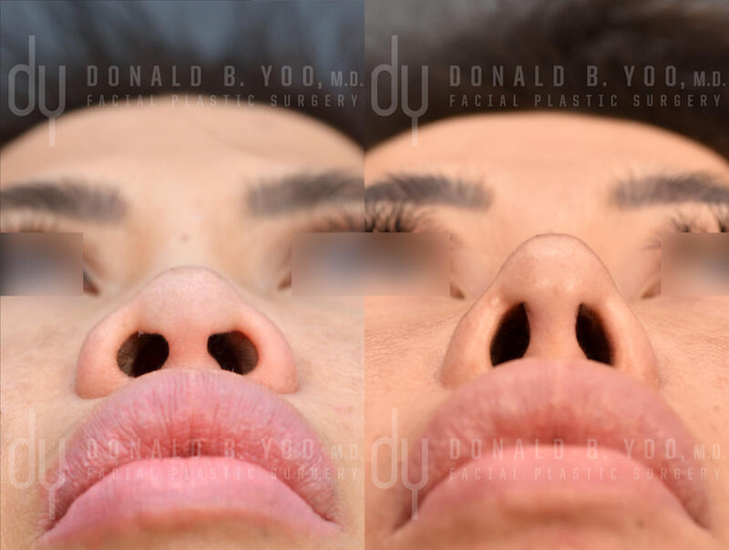 Alarplasty - Beverly Hills Facial Plastic Surgery - Donald B. Yoo M.D.