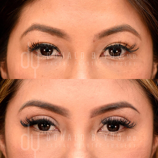 Before and after photo of Asian Eyelid Surgery