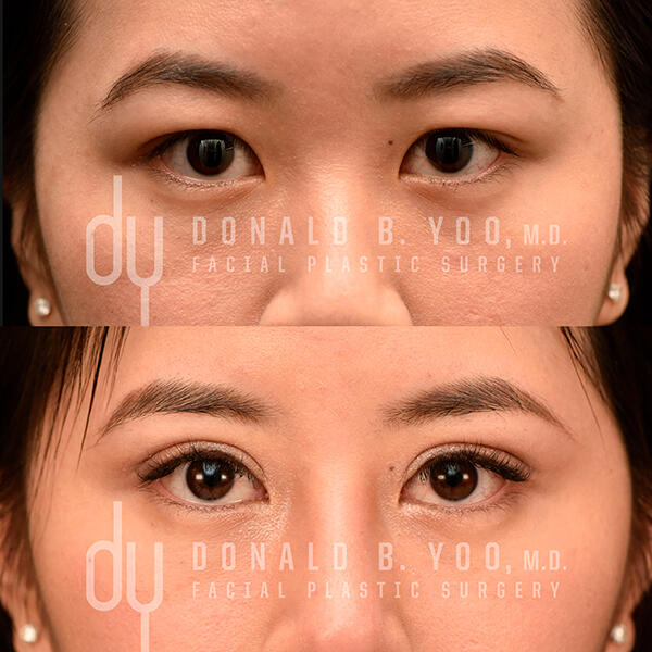 Front view of before and after photo of Asian Blepharoplasty results