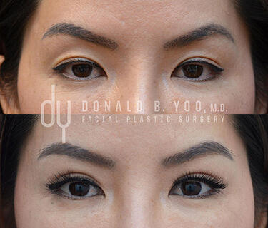 asian blepharoplasty infold/tapered crease before and after