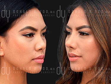 Before and After Photo of Asian Rhinoplasty Procedure