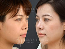 Asian rhinoplasty surgical procedure (before and after)