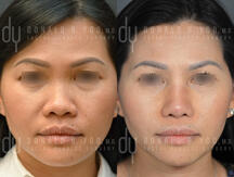 surgical Asian rhinoplasty with rib cartilage and diced cartilage fascia (DCF)