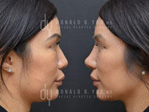 Revision Asian Rhinoplasty (before and after)