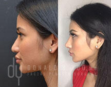 Revision Asian Rhinoplasty with rib cartilage and DCF