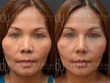Surgical Asian rhinoplasty with rib cartilage