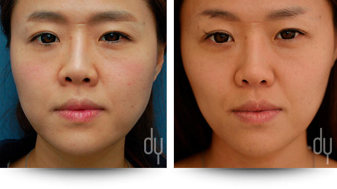 Before and After Photo of Masseter Reduction / V-line Procedure Results
