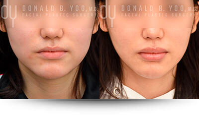 Buccal Fat Pad Removal before and after