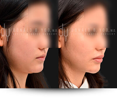 Before and after of Buccal Fat Pad Removal