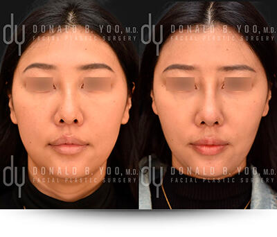 Buccal Fat Pad Removal patient photo