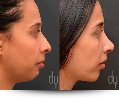 Chin Augmentation before and after