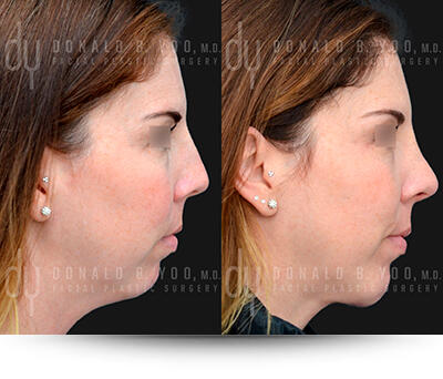 Chin Augmentation / Implant Procedure