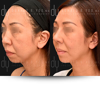 Chin Implant Results