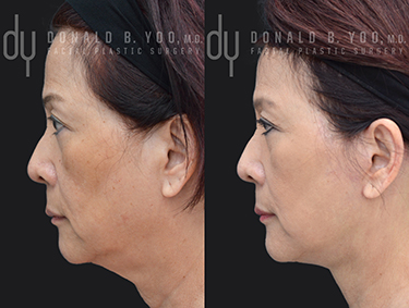 Facelift Before and After Facelift Before and After