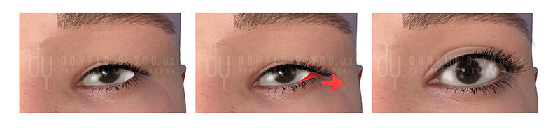 Lateral canthoplasty