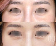 Lower Eyelid surgical procedure (before and after)