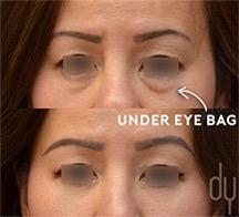 Lower Eyelid Under Eye Bag Removal